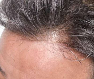 生え際